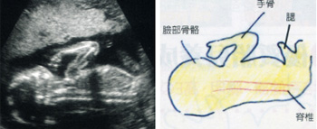 图解怀孕中期b超(13-24周)