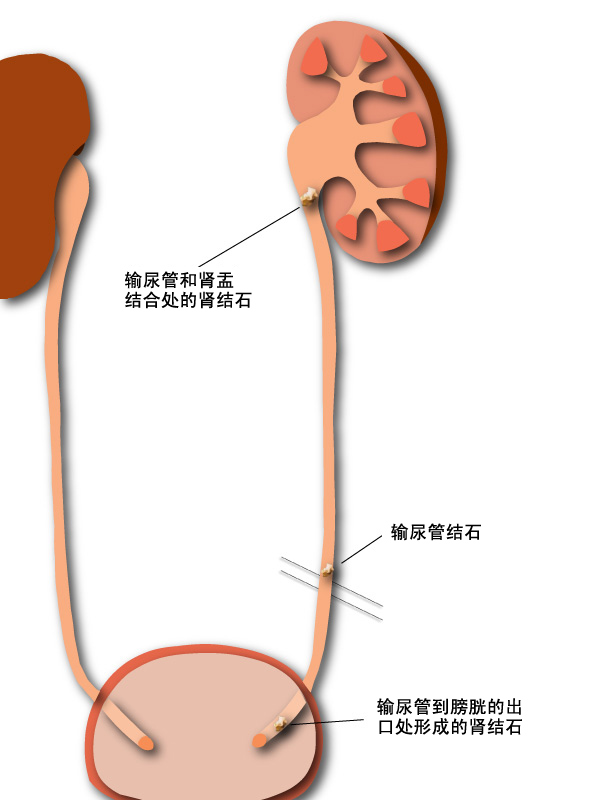 stages-of-passing-a-kidney-stone-kidney-stone-passing-process-with